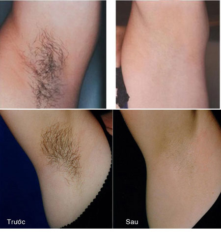 hình ảnh trị liệu trước và sau khi triệt lông