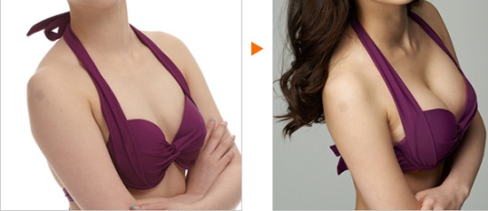 hình ảnh trị liệu trước và sau khi nâng ngực